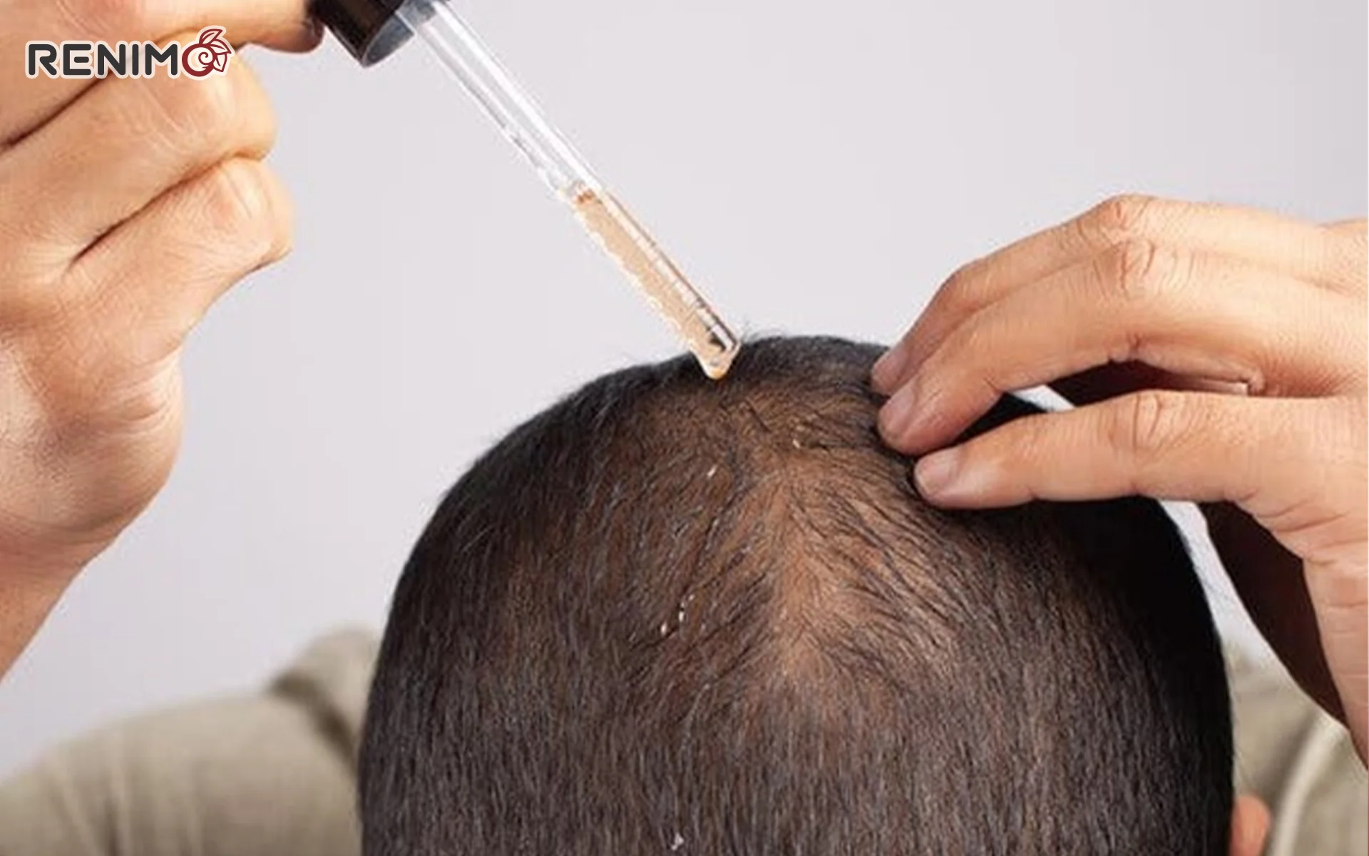 ریزش موهای خود را چگونه درمان کنیم؟