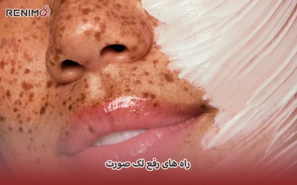 راه های رفع لک صورت